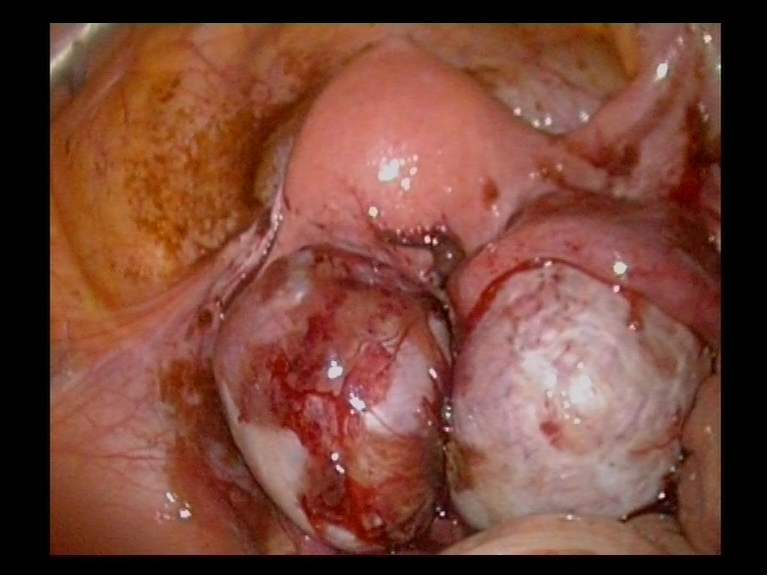 Choclate Endometriotic Cysts Choclate Endometriotic Cysts